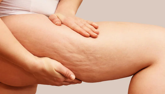 Comprendre la cellulite Cellulisse®